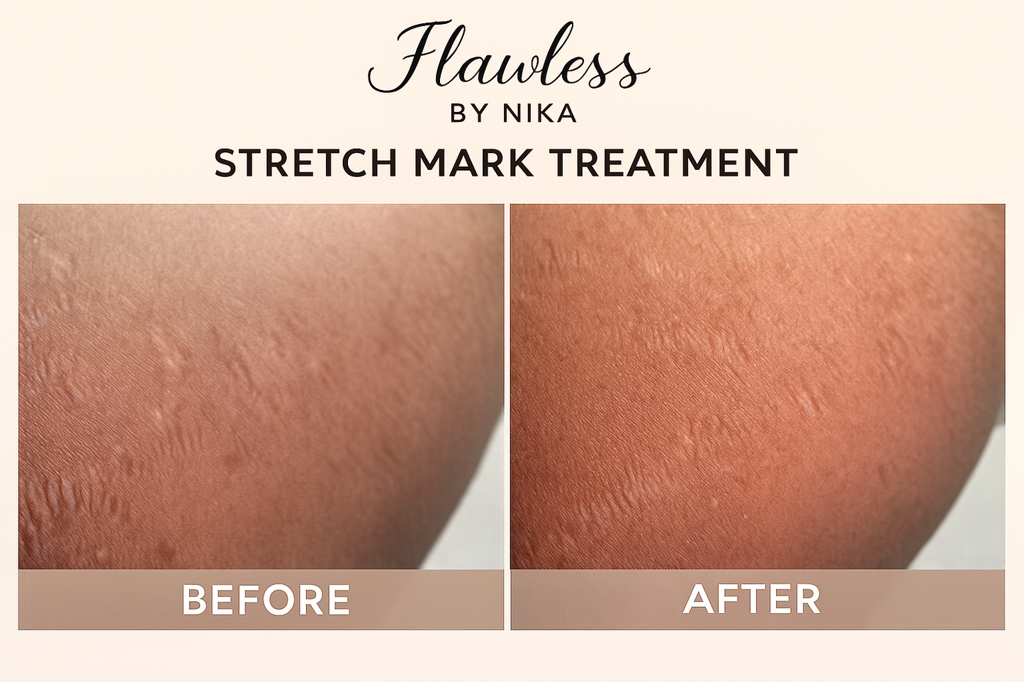 STRECTH MARKS AND IMPERFECTIONS KIT