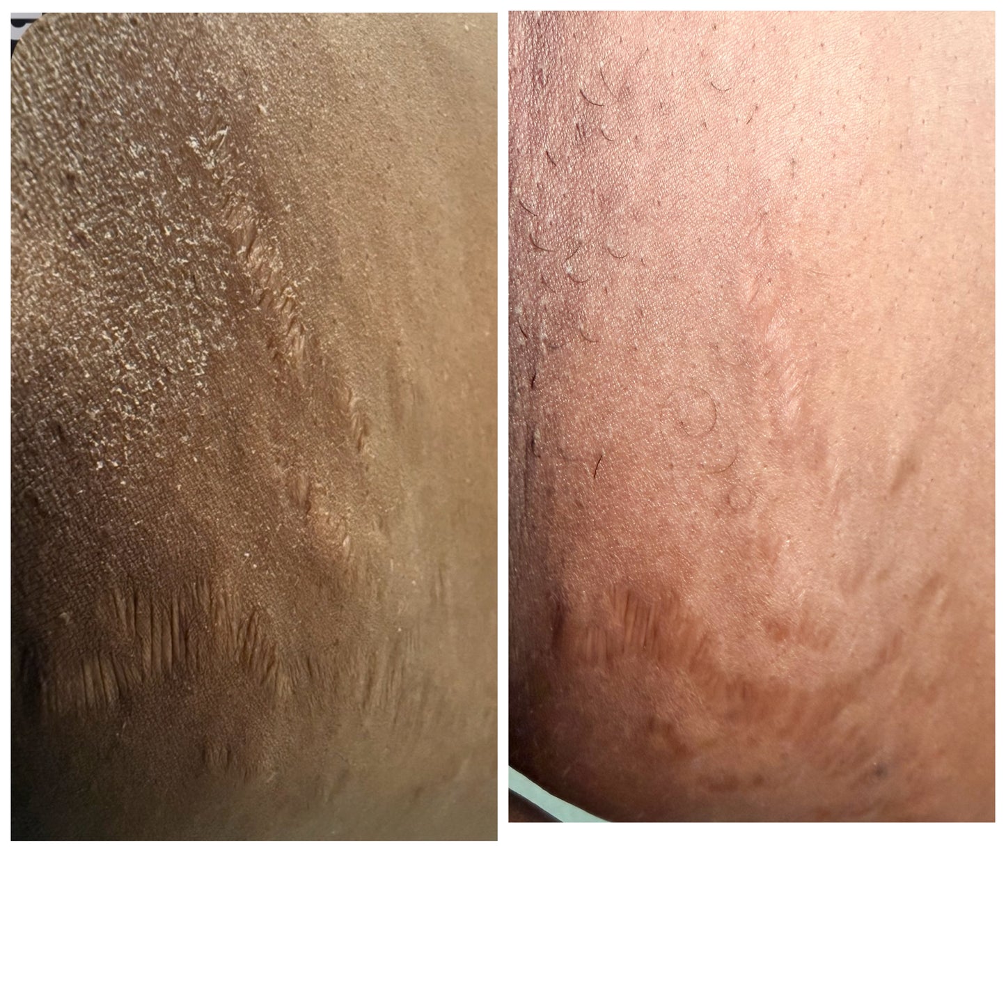 STRECTH MARKS AND IMPERFECTIONS KIT