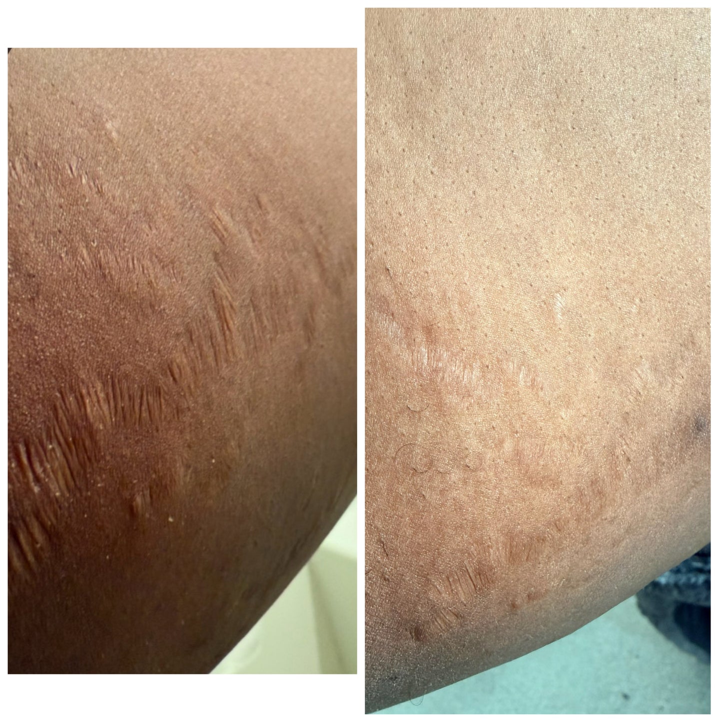 STRECTH MARKS AND IMPERFECTIONS KIT