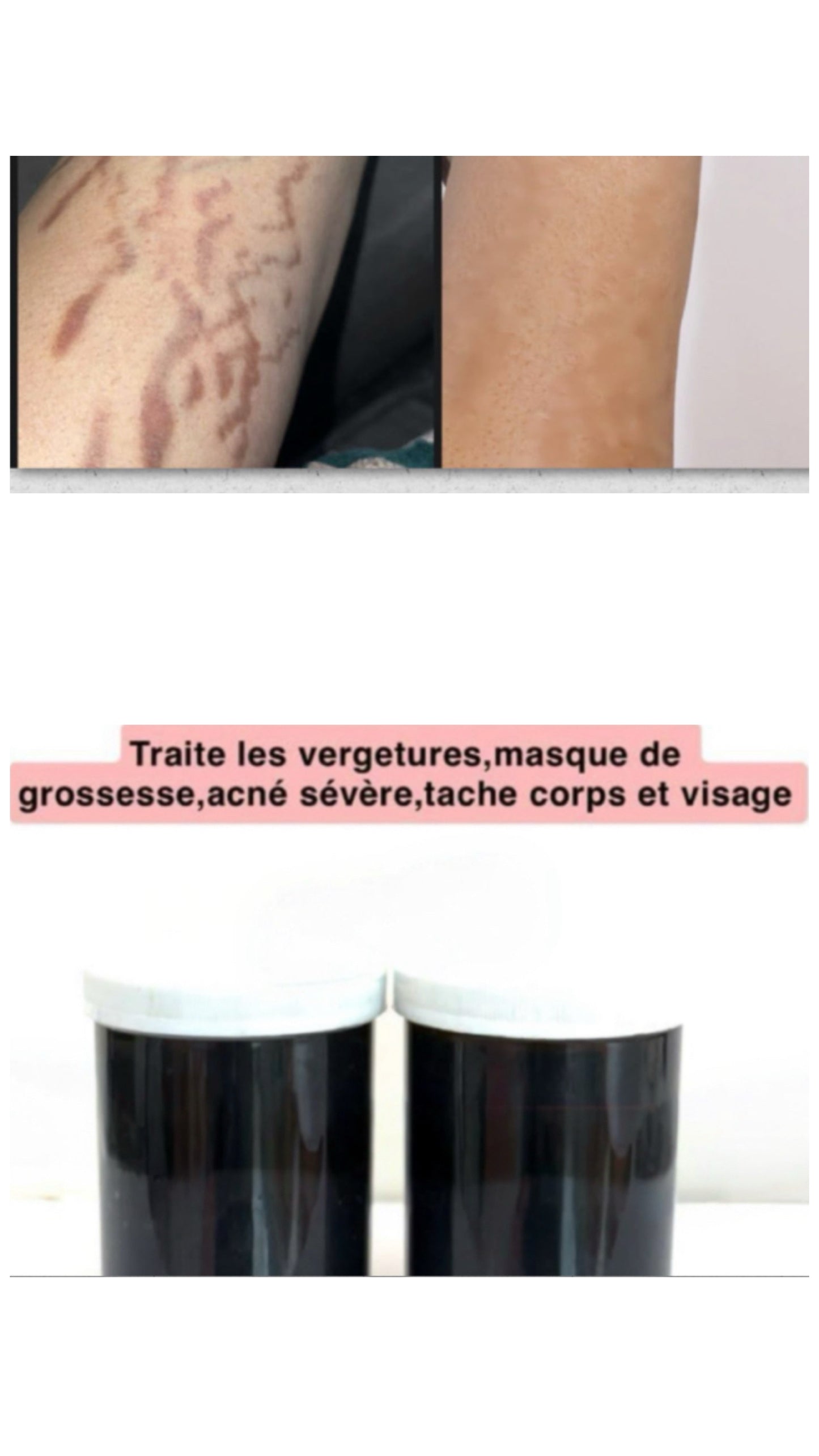 STRECTH MARKS AND IMPERFECTIONS KIT